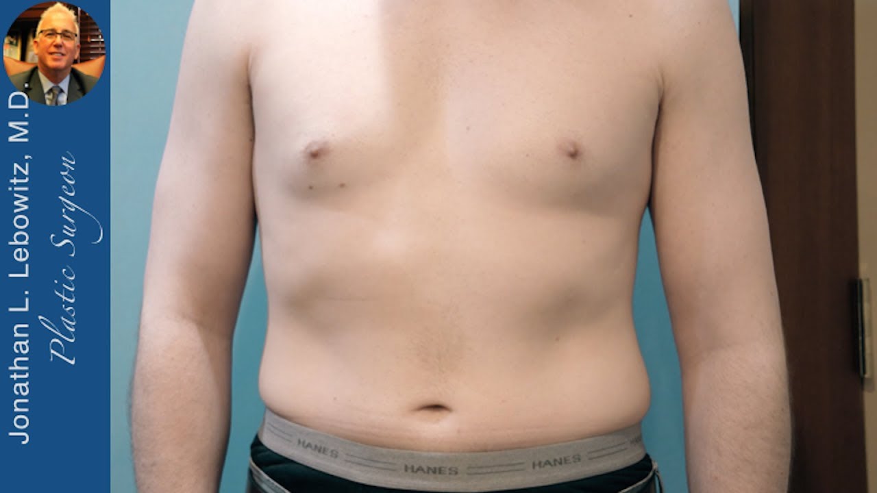 Gynecomastia Glands 🍳 Removed, FAT Contoured At The Long Island ...