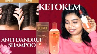 KETOKEM ANTI-DANDRUF SHAMPOO REVIEW || REMOVE DANDRUFF WITH MEDICATED SHAMPOO || HONEST REVIEW