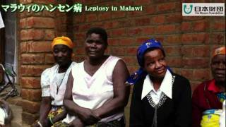 【現地リポート】アフリカ・マラウィのハンセン病事情 / Leprosy in Malawi