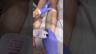 Waxing male legs with soft wax