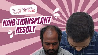 Hair Transplant Before \u0026 After – Stunning Results at Medi Skin \u0026 Hair Clinic