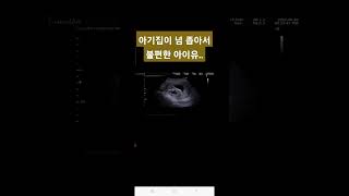 양수부족! 임신12주 초음파 아기 ㅣ아기집이 넘 작아서 머리 엉덩이가 끼어요 미안해 아이유..ㅣ노산임산부