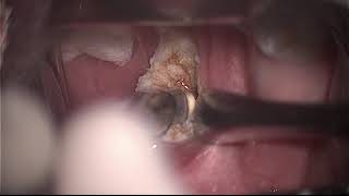 coblation intracapsular tonsillectomy by Dr Vikas Agrawal- truly bloodless painless