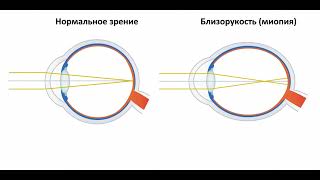 Звідки береться короткозорість і як її лікувати