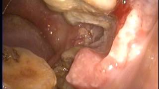 口腔癌 之一 ： 頰粘膜癌 oral cancer: buccal cancer Dr. Ken-Liao Liu