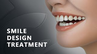 SMILE DESIGN TREATMENT