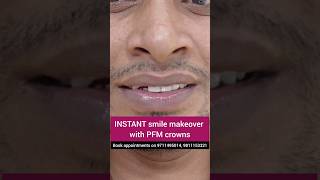 INSTANT Smile Makeover with PFM crown; Dr. Srishti Bhatia #smile #smilemakeover