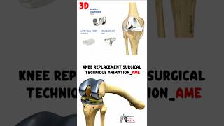 Knee Replacement Surgical Technique Animation_AME #medical #animation #3d #short |Biology with Aliya