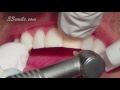 Prepless Veneers Dental Procedure at Cosmetic Dental Associates in San Antonio, TX