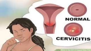 How to identify cervicitis and how to treat women early