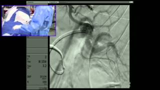 Transradial Embolization of a Splenic Artery Aneurysm - Part 2: Embolization - 6 min cut