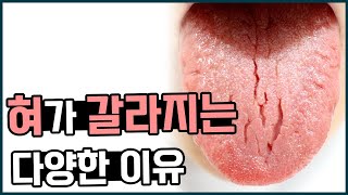 혀갈라짐 원인/ 혀가 점점 갈라지고 혀가 갈라진 곳이 아파요.