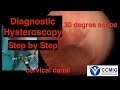 Diagnostic Hysteroscopy Step by Step