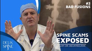 Spine Scams Exposed | Multiple Back Surgeries (EP.3)