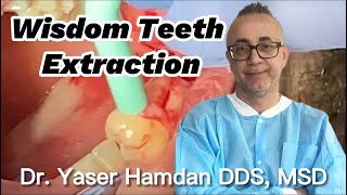 Wisdom teeth extraction. Minimally invasive, no sutures needed #wisdomteeth #oralhealth #dentist