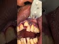 dr. kira toulson performs a dual arch case with yomi