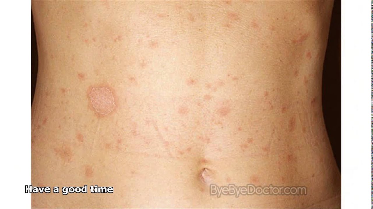 Fungal Skin Rash - YouTube