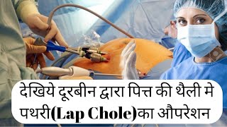 Gall bladder removal surgery. दूरबीन द्वारा पित्त की थैली का औपरेशन कैसे करते हैं?