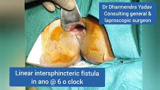 Fistula in Ano