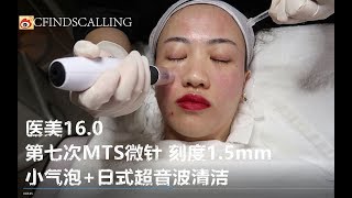 医美16.0/ 第七次MTS微针 刻度1.5mm/ 更新前后对比图/ 小气泡+日式超音波清洁