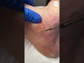 callus removal from midfoot