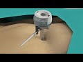 disposable endoscopic linear cutter stapler and reloads