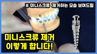 치아교정 미니스크류 제거는 어떻게 하나요?