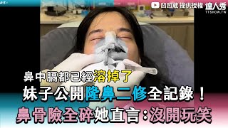 【妹子公開隆鼻二修全記錄！ 鼻骨險全碎她直言：沒開玩笑】｜@ououyu