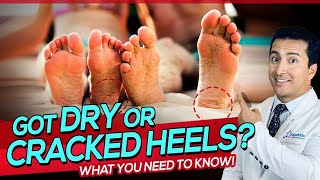 A Diabetic Skin Problem: Dry, Cracked Heels. Causes \u0026 Remedies.