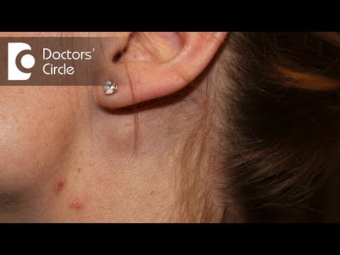 Do lymph nodes swell with ear infection?