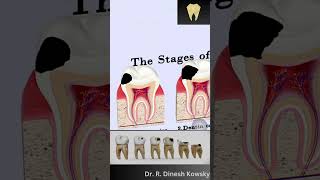 Tooth Cavity explained in 3- D