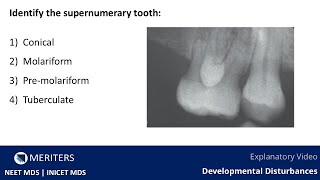 NEET MDS | INICET - Developmental Disturbances | Explanatory Video | MERITERS #neetmds2025