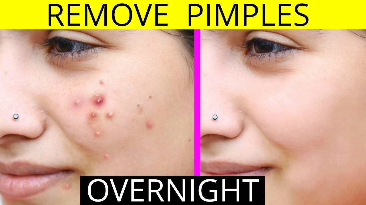 How To Remove Pimples Overnight | Acne Treatment | Anaysa - YouTube