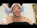 The Hollywood Laser Peel - Look Your Best with No Downtime! | Dr. Manjoney on The Morning Blend