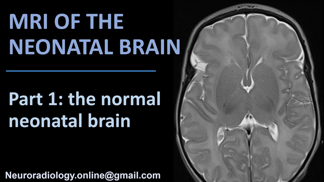 Normal Brain Mri