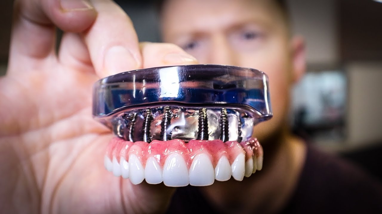 The Same Day Teeth Experience: Exploring Full Mouth Dental Implants ...