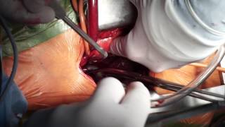 Double Superior Vena Cava Cannulation for Venous Drainage in Minimally Invasive Aortic Valve Surgery