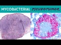 Infection mimicking a Tumor!? (Mycobacterial Pseudotumor from AFB) pathology dermpath dermatology