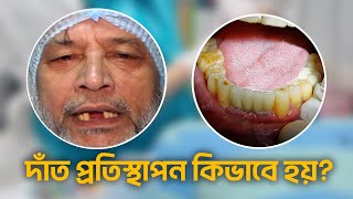 ডেন্টাল ইমপ্লান্ট কিভাবে হয় সরাসরি দেখুন।Dental Implant bangladesh | Cost , Procedure \u0026 Duration