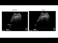 gastric ultrasound to verify full or empty stomach this is easy to learn