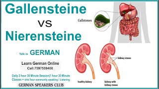 Gallensteine vs Nierensteine | Sprächthema | for A2 \u0026 B2 | Stammtisch Deutsch | Talk in German