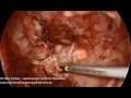 Laparoscopic Anterior Resection - English