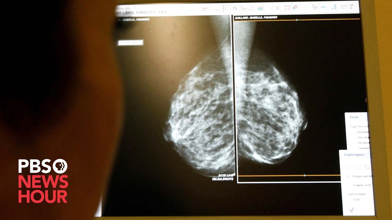 New Guidelines Recommend Earlier Mammograms Amid Rise In Breast Cancer ...