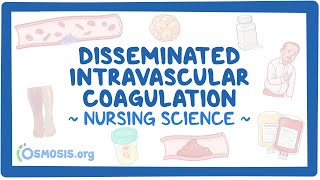Disseminated intravascular coagulation (DIC): Clinical Nursing Care