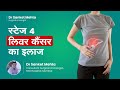 लिवर कैंसर स्टेज ४ का इलाज  |  Treatment for Stage 4 Liver Cancer | Dr  Sanket Mehta