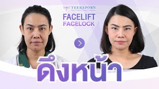 รีวิวดึงหน้า Facelift คุณบี อายุจะ 46 แล้วหน้าก็ยังตึงอยู่ ธีรพรคลีนิก หมอชลธิศ