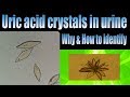 Uric acid crystals in urine (Why & How to identify)