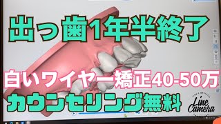 出っ歯　1年半でスピード矯正　白いワイヤー矯正５０万〜　大宮　鈴木歯科医院・矯正歯科医院　抜歯矯正　安い費用