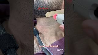 Laser Hair Removal Treatment #getsmarthairclub #hair  #viralvideo #hairremoval