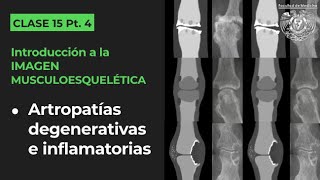 15.4 - Artropatías degenerativas e inflamatorias (osteoartritits, artritis reumatoide, gota, etc.)